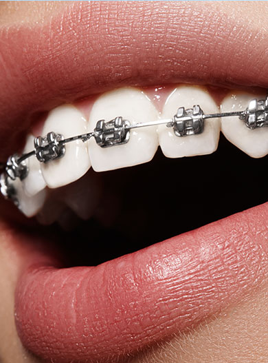 metal braces